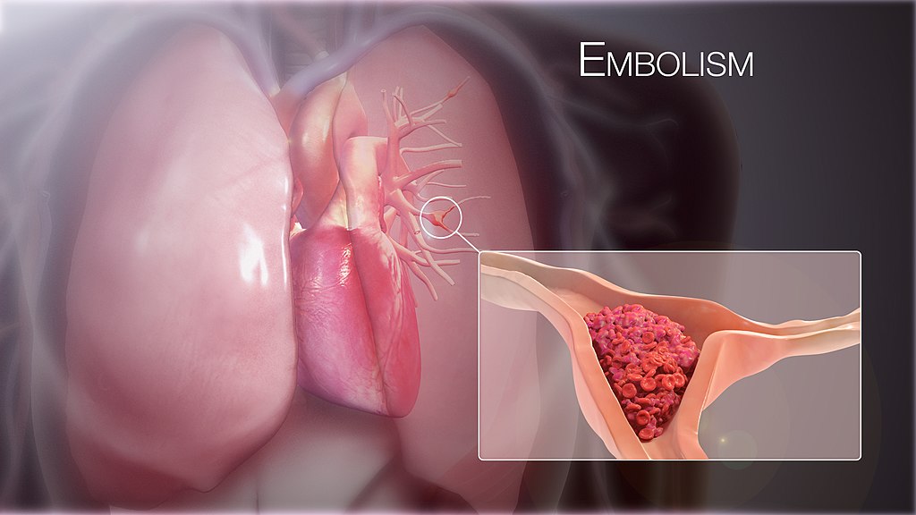 Embolism