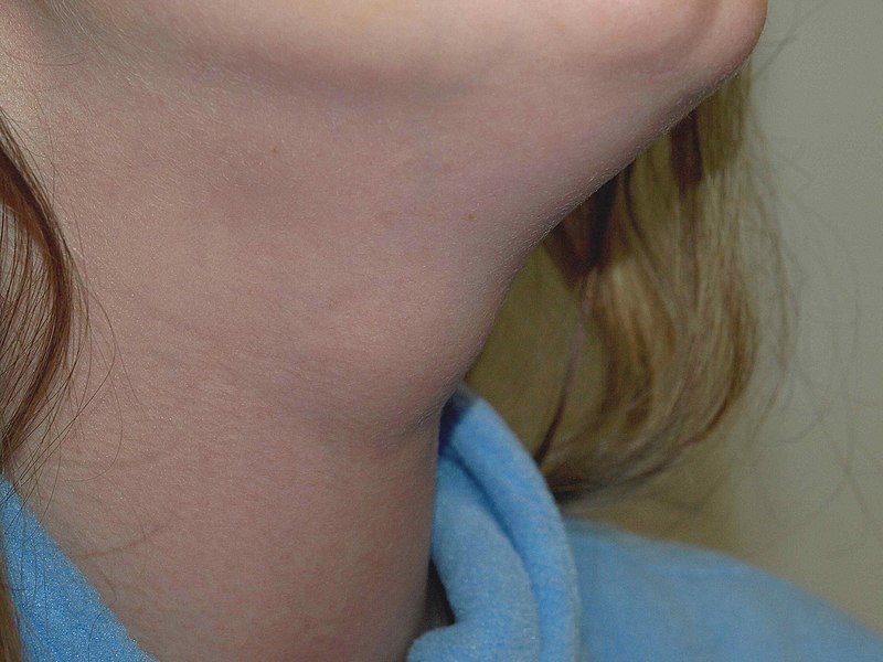 Thyroglossal Duct Cyst
