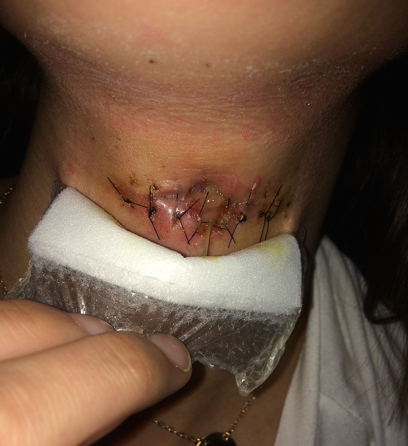 Thyroglossal Duct Cyst