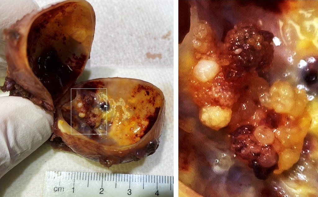Thyroglossal Duct Cyst