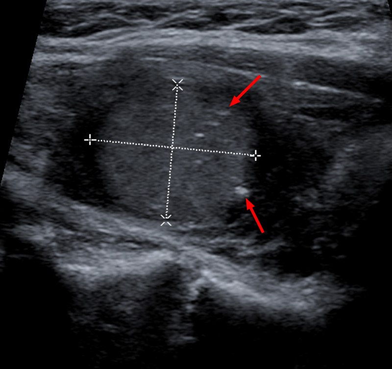 Medullary Thyroid Carcinoma