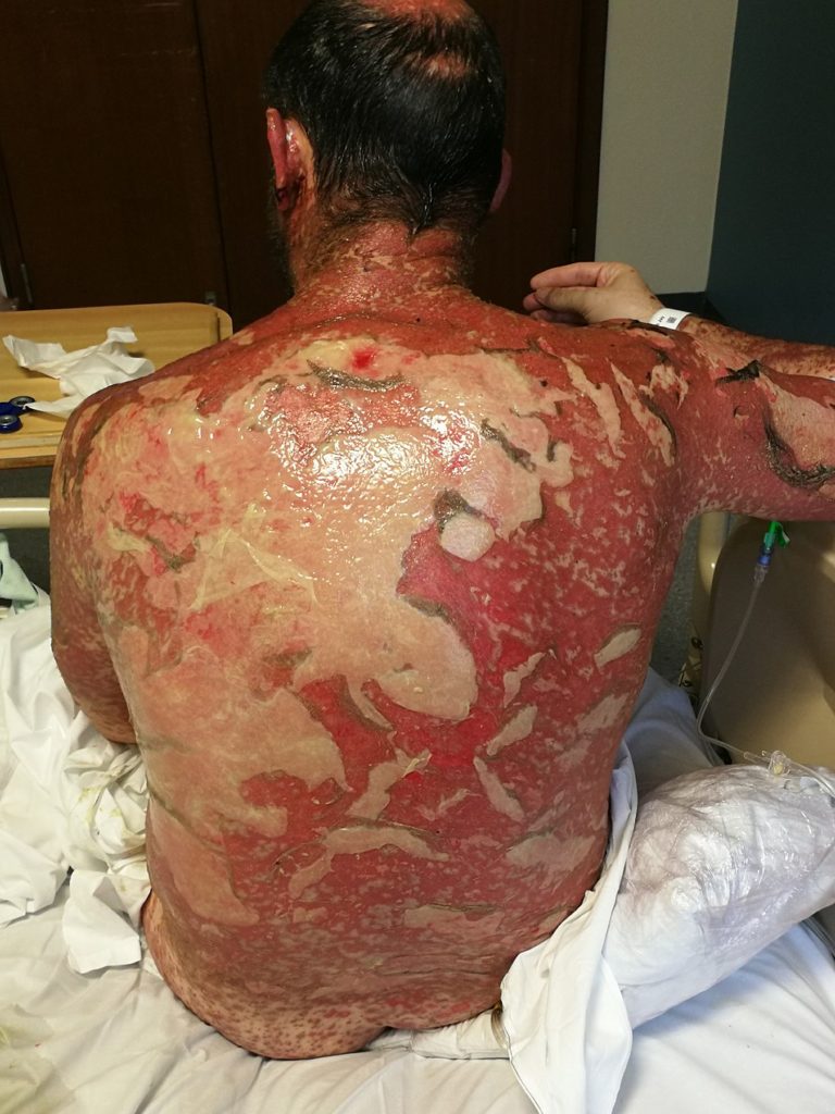 Toxic epidermal necrolysis