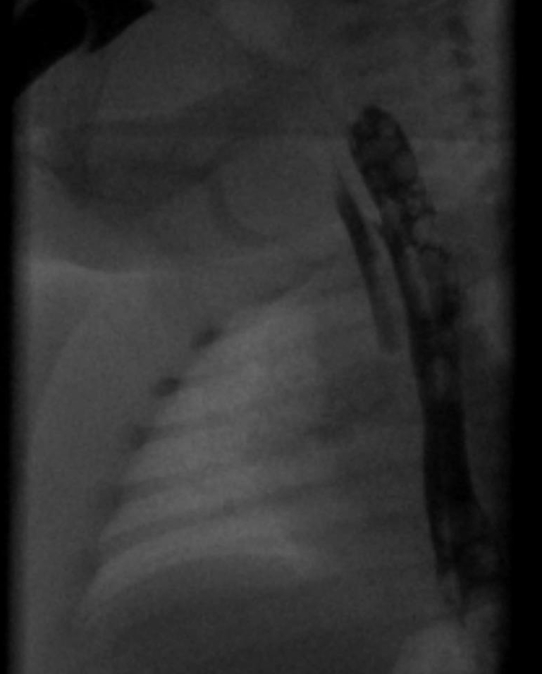 Tracheoesophageal Fistula