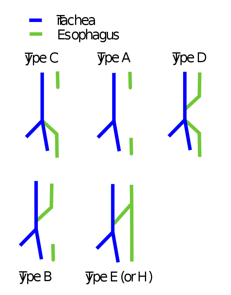 Tracheoesophageal Fistula
