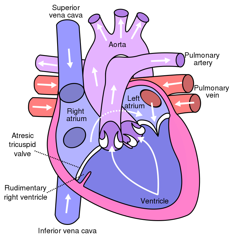 Tricuspid Atresia