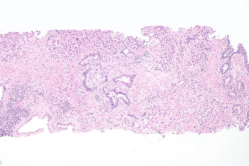 Urothelial Carcinoma