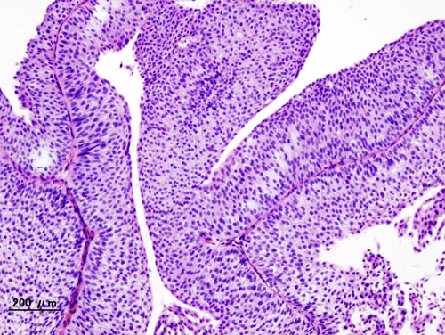Papillary Urothelial Carcinoma