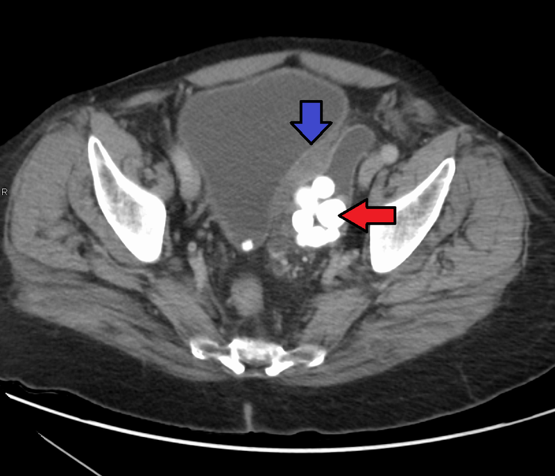 Urothelial Carcinoma