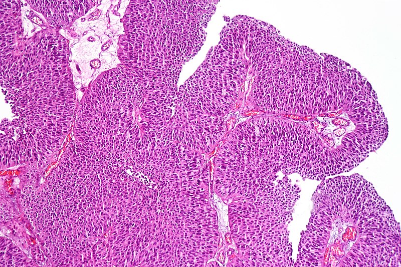 Urothelial Carcinoma