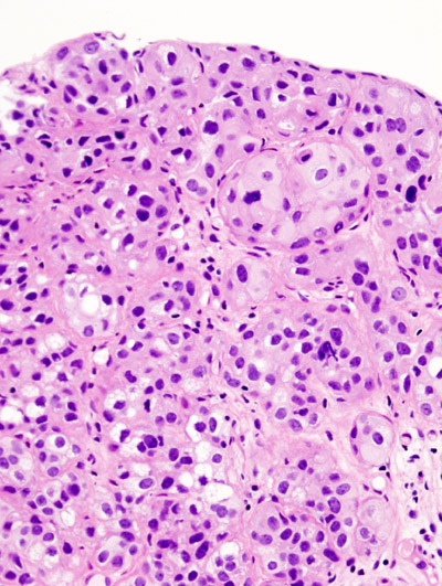 Urothelial Carcinoma