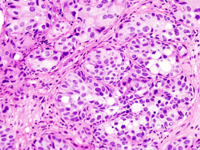 Urothelial Carcinoma