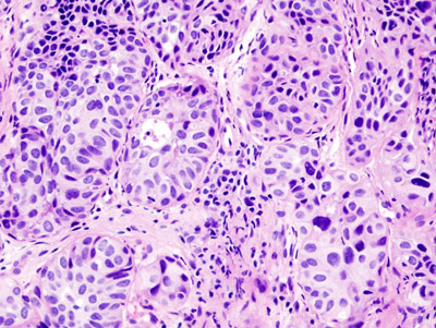 Urothelial Carcinoma