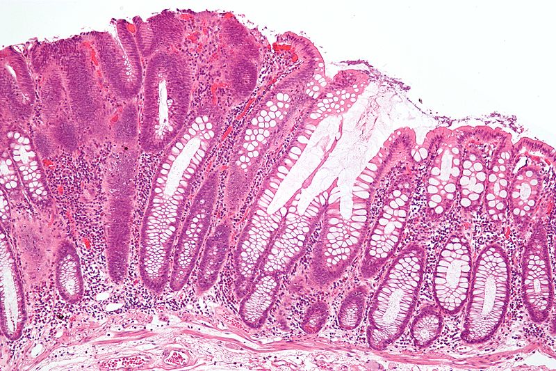 Vaginal Carcinoma