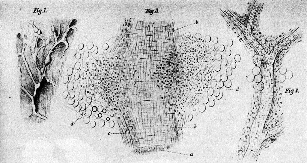 Polyarteritis Nodosa