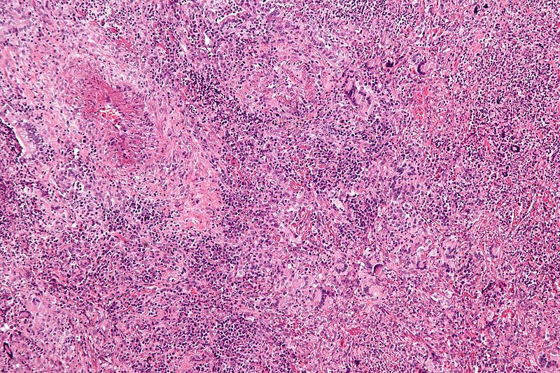 Wegener Granulomatosis