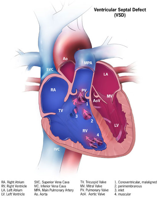 Ventricular Septal Defect (VSD)
