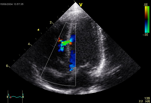 Ventricular Septal Defect (VSD)