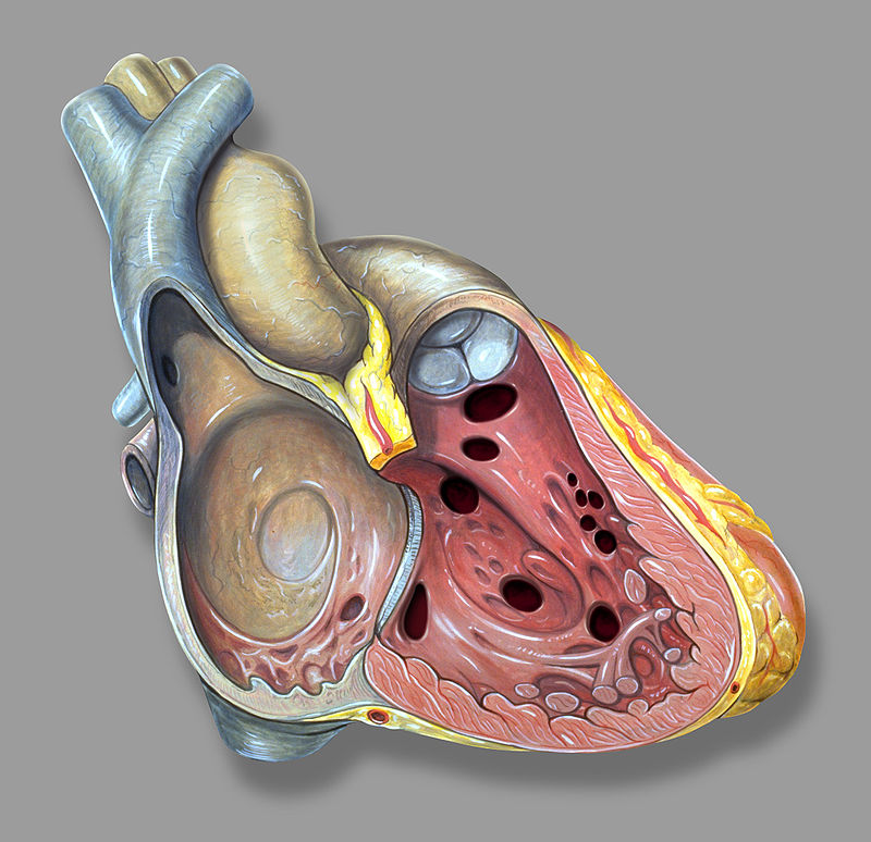 Ventricular Septal Defect (VSD)
