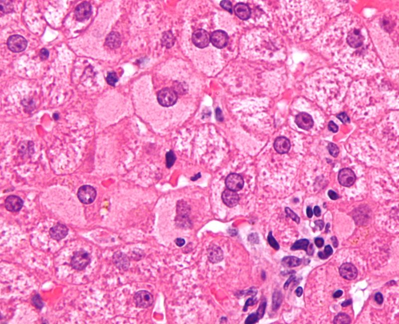 Viral Hepatitis