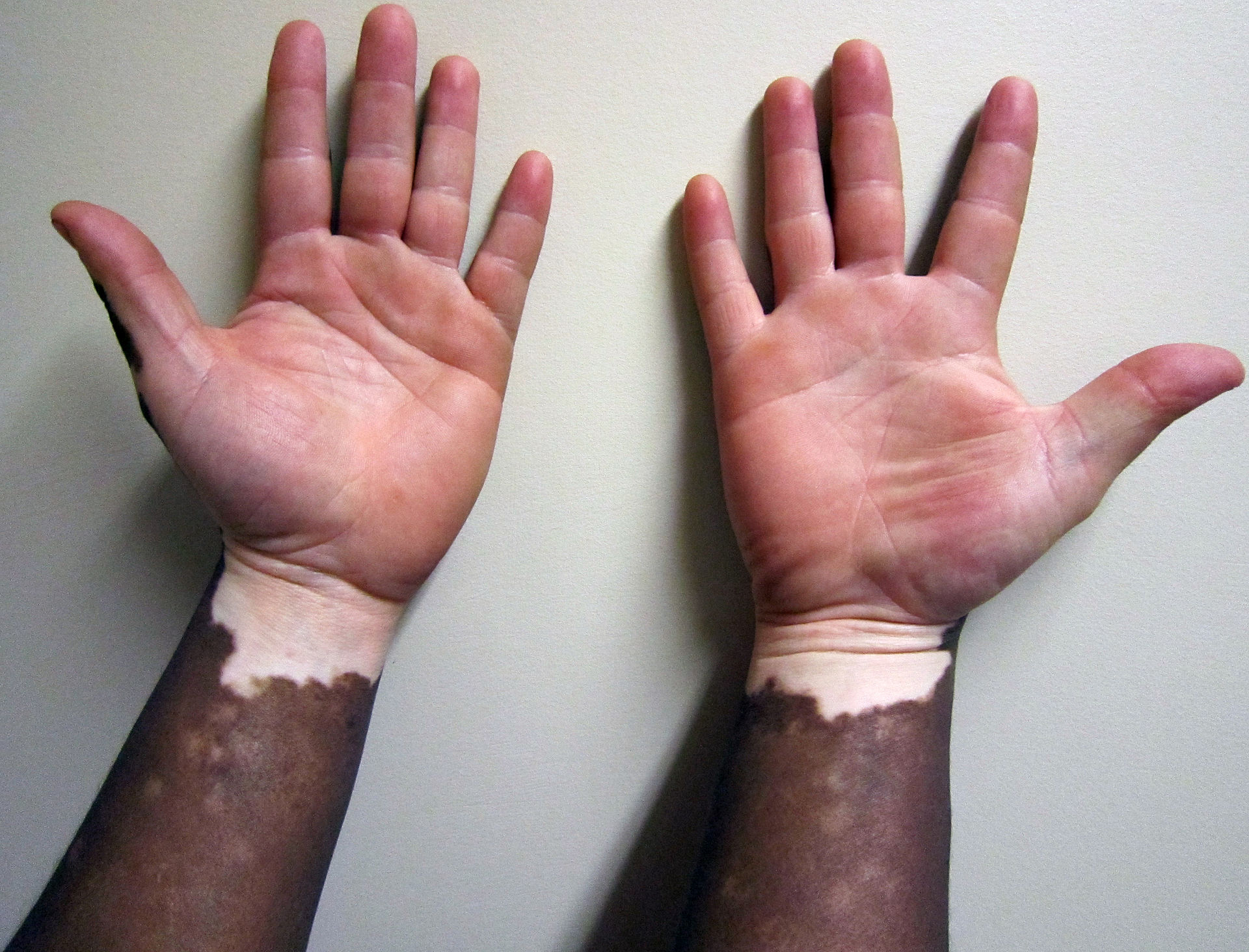 Vitiligo