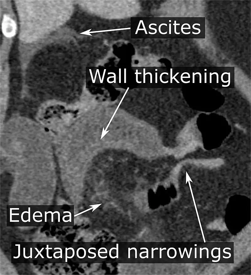 Volvulus