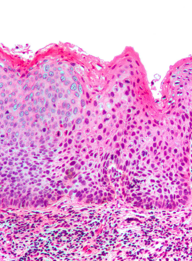 Vulvar Carcinoma