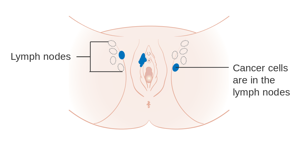 Vulvar Carcinoma