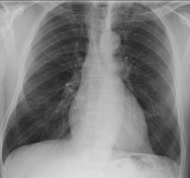 Wegener Granulomatosis