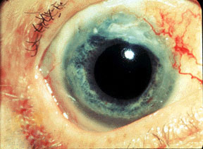 Wegener Granulomatosis