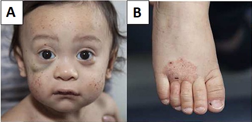 Wiskott Aldrich Syndrome