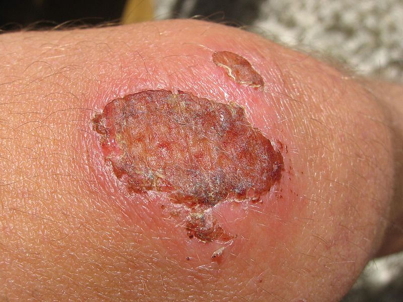 Wound Healing