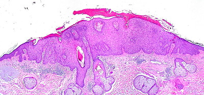 Actinic Keratosis
