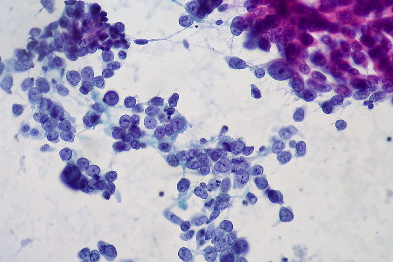 Adenocarcinoma of lung, FNA