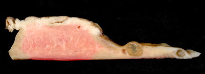 Adenocarcinoma of the Endometrium