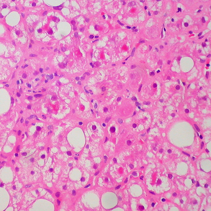 Alcoholic Cirrhosis, Mallory Hyaline