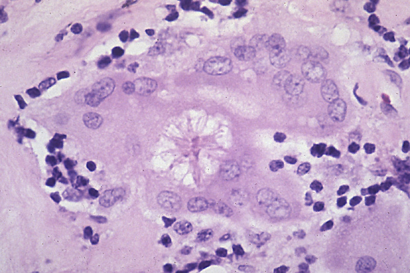 Asteroid Body in Sarcoidosis