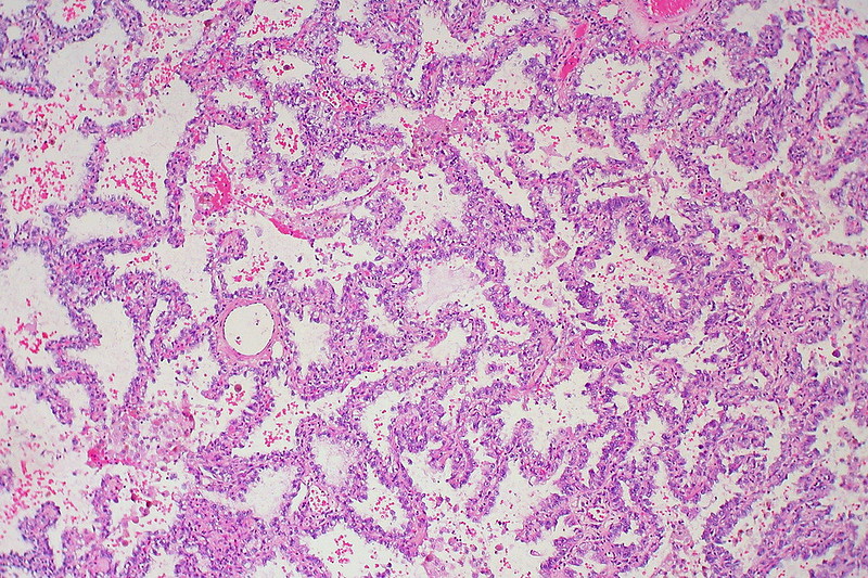 Bronchioloalveolar Cell Adenocarcinoma of the Lung