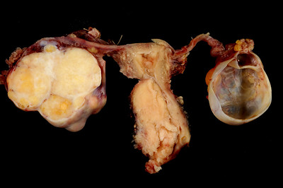 Cervical Carcinoma with Adnexa
