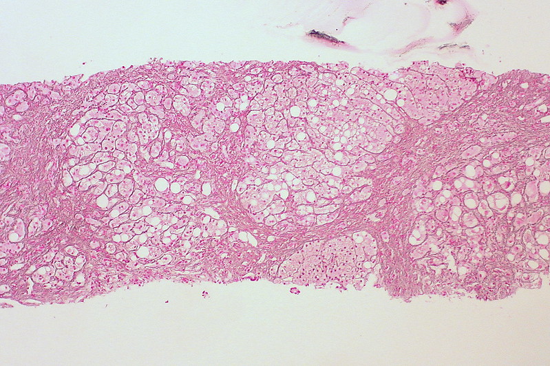 Cirrhosis of Alcoholic Liver Disease