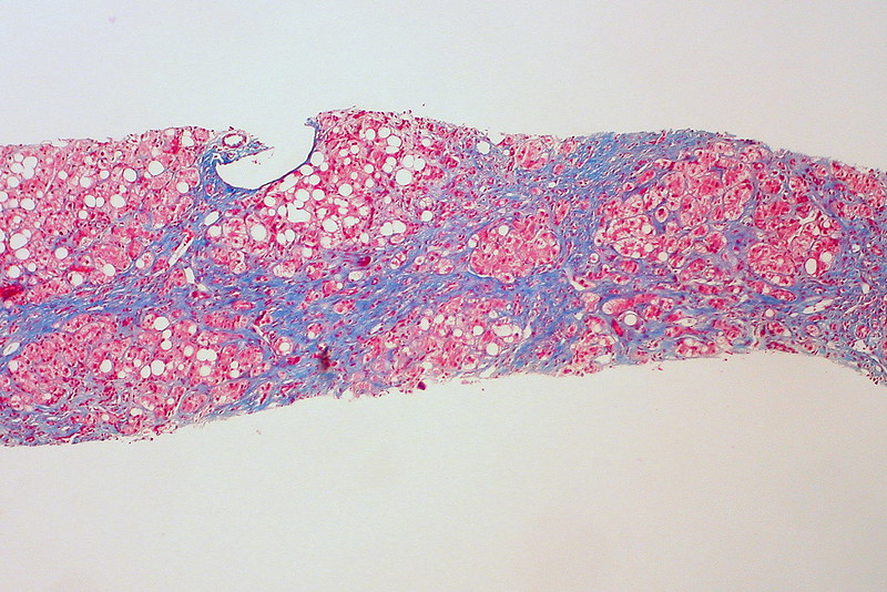 Cirrhosis of Alcoholic Liver Disease