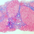 Cirrhosis of the liver (trichrome stain)