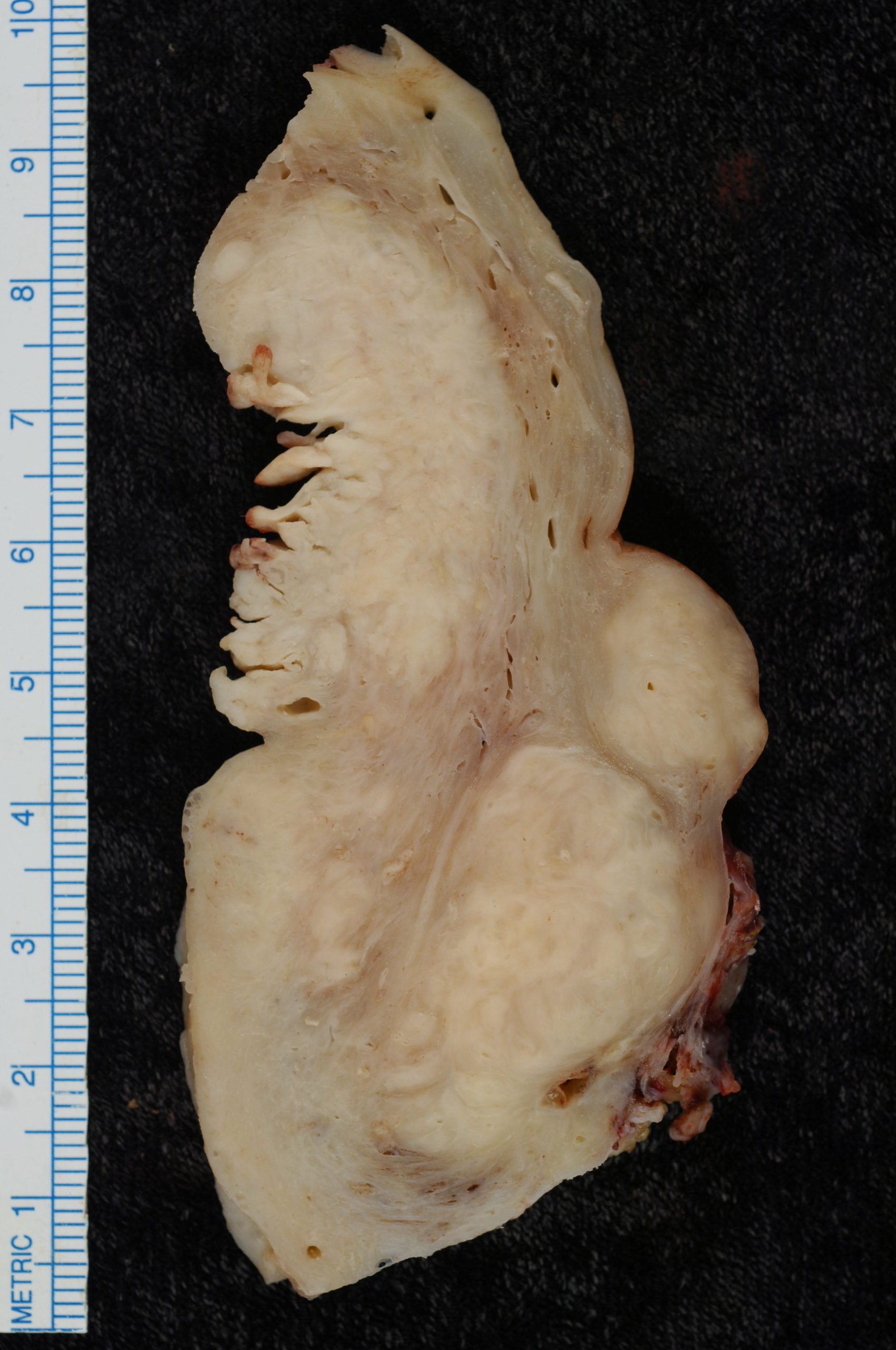 Endometrial Adenocarcinoma