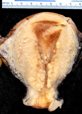 Endometrial Carcinoma