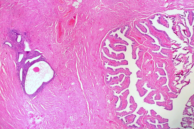 Endometriosis in Wall of Fallopian Tube