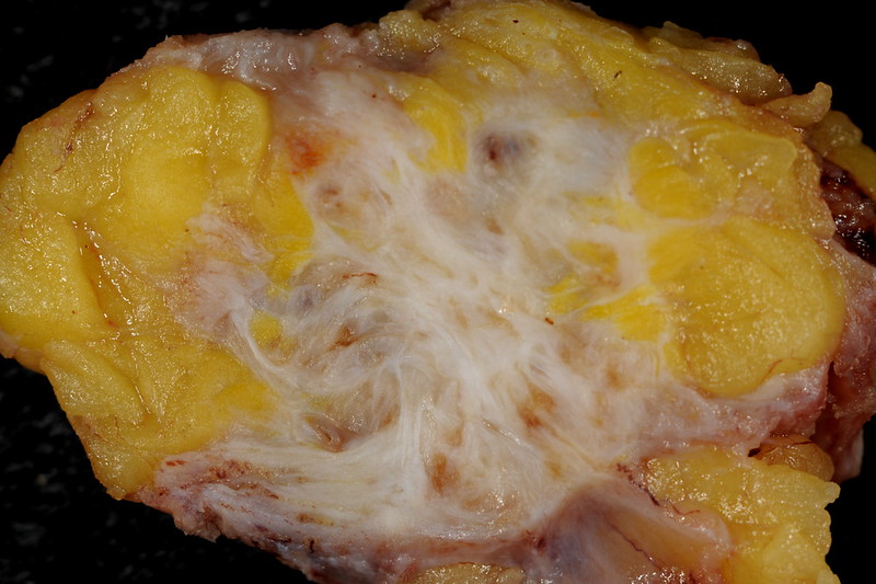 Endometriosis of Abdominal Wall