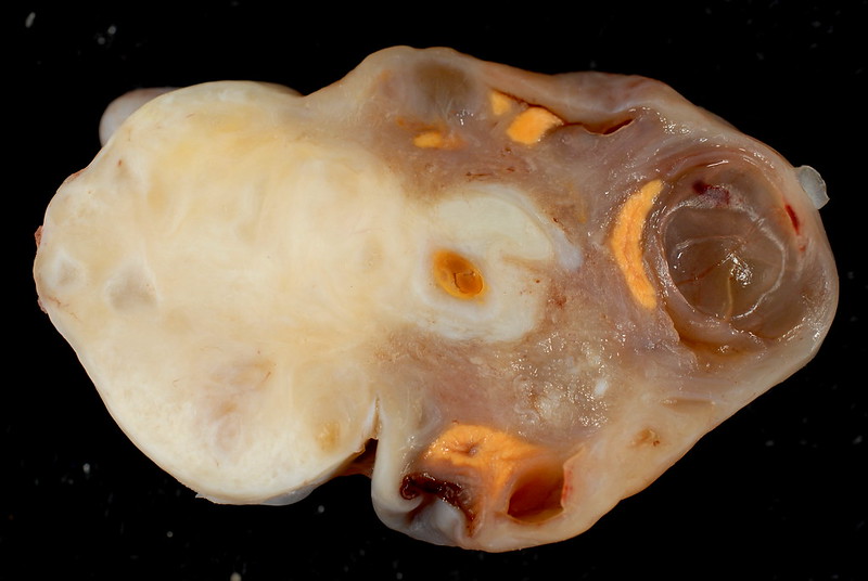 Fibroma of the Ovary