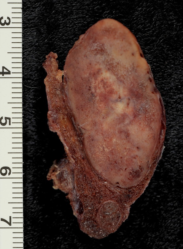 Follicular Adenoma of the Thyroid Gland
