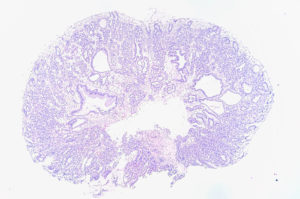 Fundic Gland Polyp of the Stomach