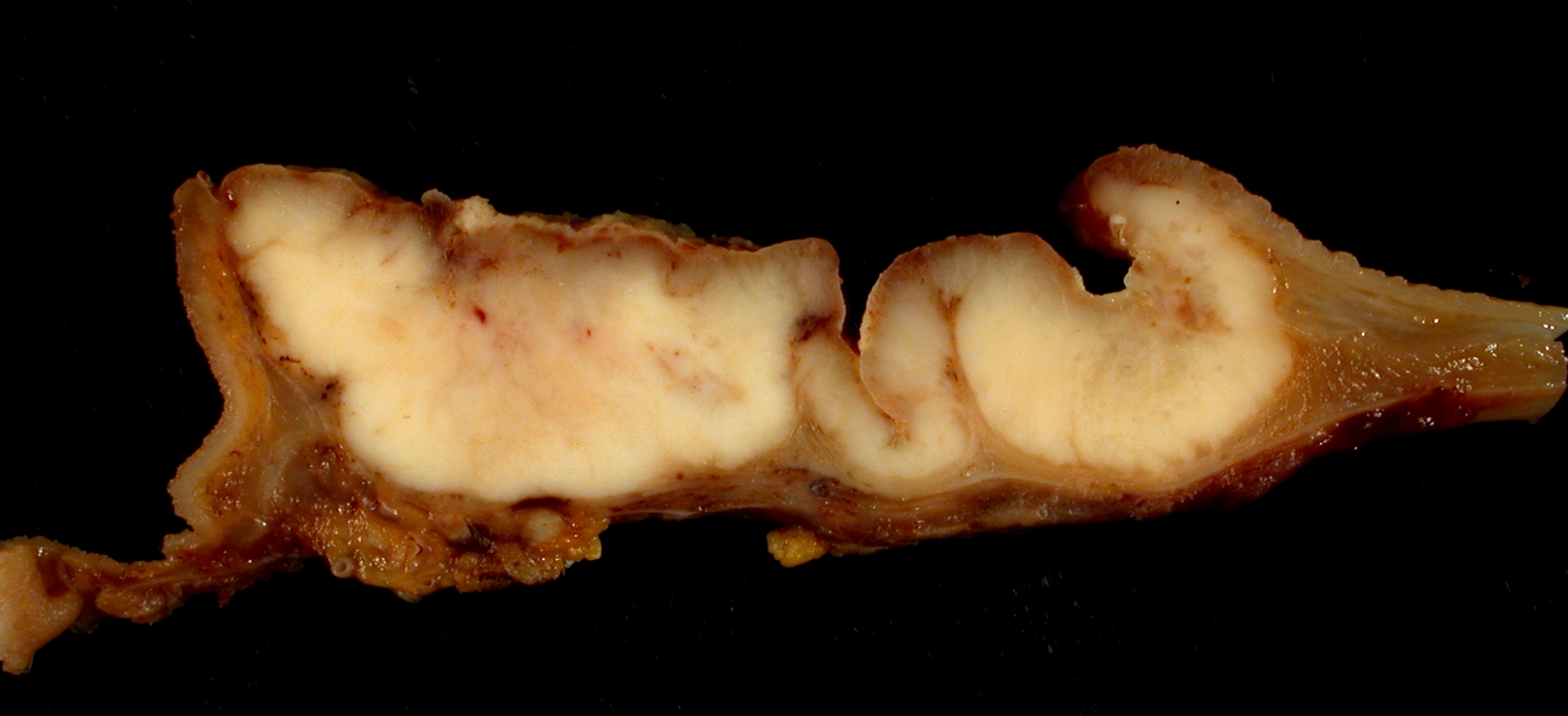 Gastric Adenocarcinoma
