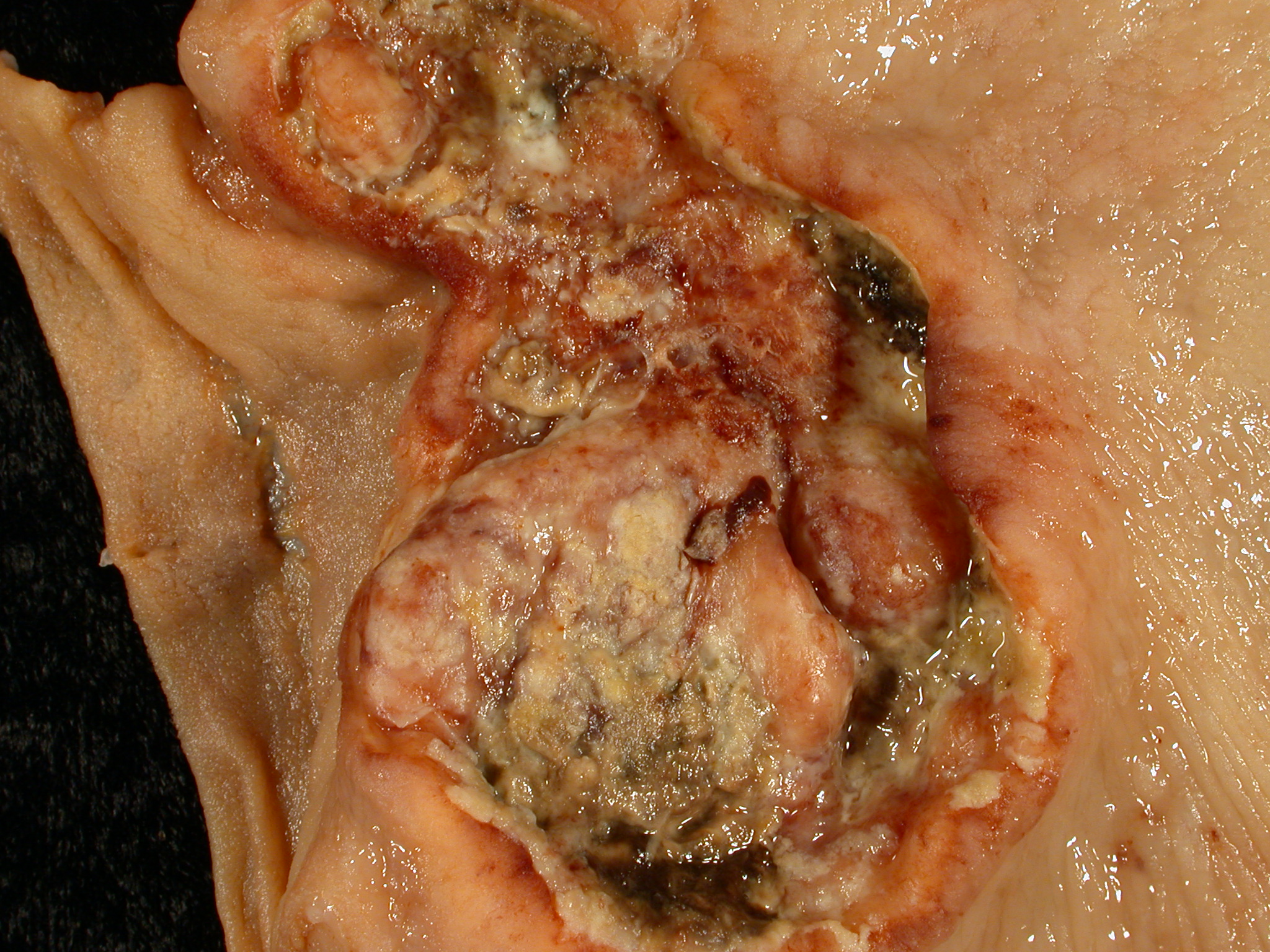Gastric Adenocarcinoma